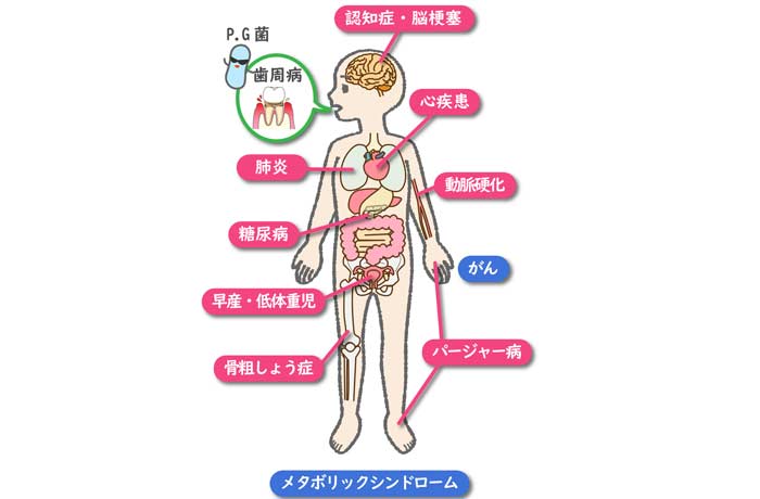 歯と病気の関係